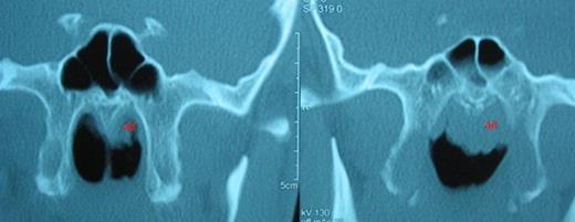 Asymmetric adenoid hypertrophy, more prominent on the left side. ad: adenoid hypertrophy