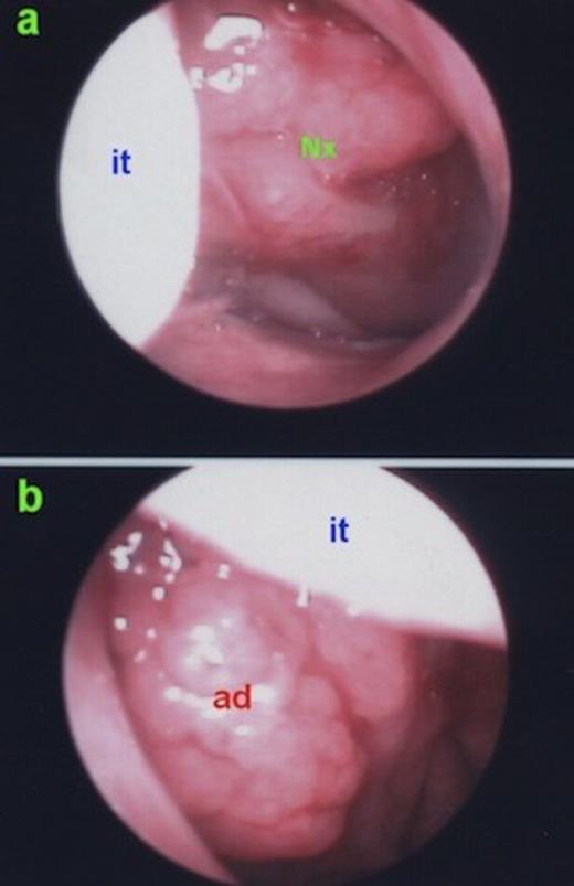 a) Right nasal cavity; clinically insignificant lymphoid hyperplasia on the nasopharynx. b) Left nasal cavity; clinically significant adenoid hypertrophy. it: inferior turbinate, ad: adenoid hypertrophy, Nx: Nasopharynx.