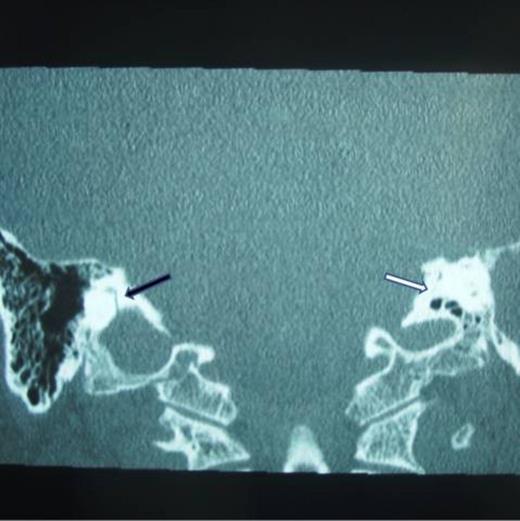Right transverse fracture (black arrow) and left longitudinal fracture (white arrow)
