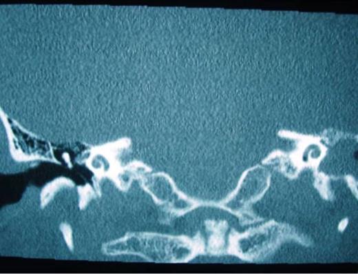 Preoperative scan demonstrating patency of both cochlea