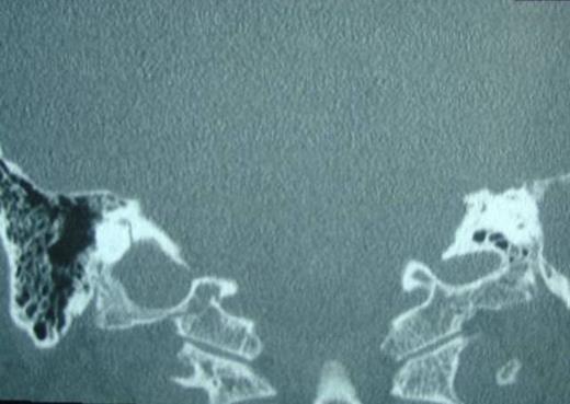 Ossification of left cochlea