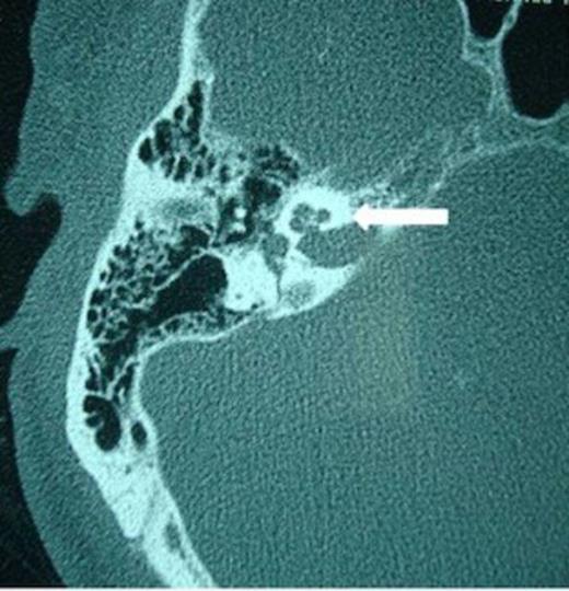 Patent right cochlea