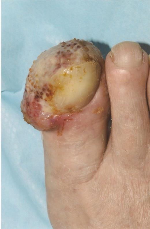 Clinical appearance of the right great toe at presentation.