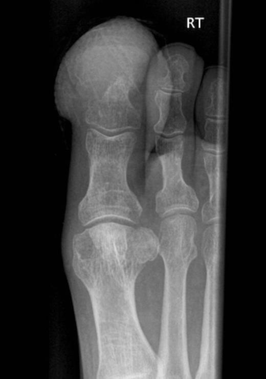 Radiograph of right great toe demonstrating osteolysis of distal phalanx with adjacent soft tissue swelling but no periosteal reaction.