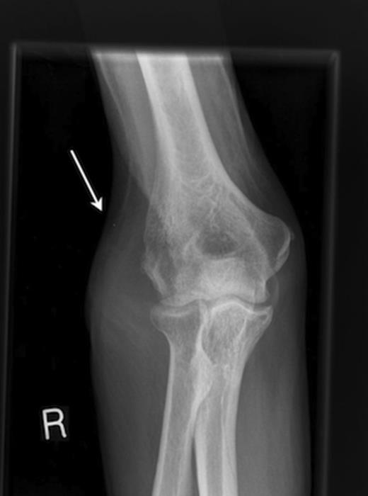 Radiograph of right elbow demonstrating a soft tissue swelling over the lateral epicondyle.