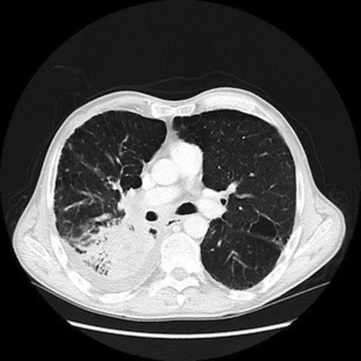 CT scan of chest demonstrating primary lung tumour in the right lower lobe.