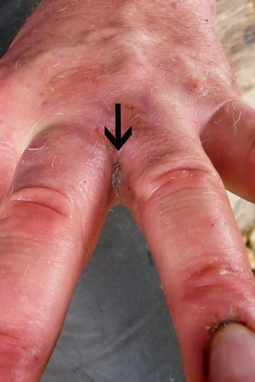 Recurrence at the original site. In the non-dominant hand, 3rd web space (arrow).