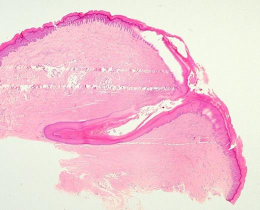 A low power cross section image (H&E x10) of the pilonidal sinus imaged with a digital macro lens.