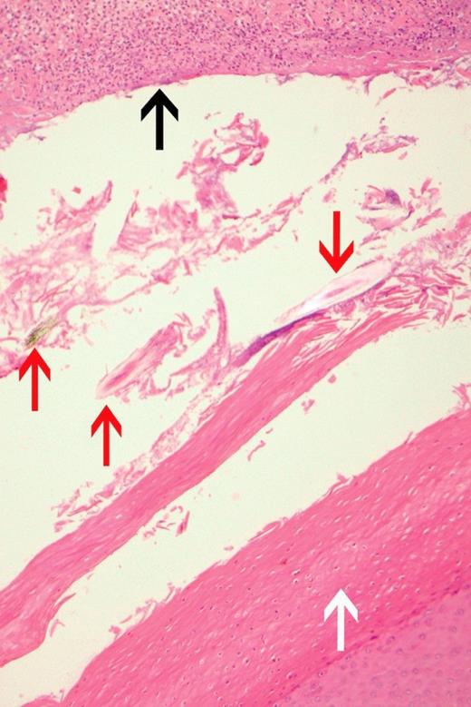 A high power image (H&E x100) of the sinus displaying epithelial lining of the sinus (white arrow), ulceration (black arrow) and multiple different coloured wool fragments (red arrows).