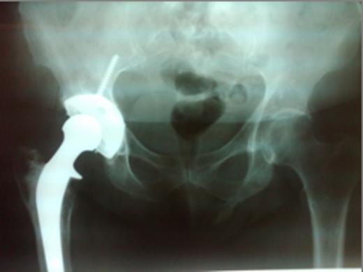 Plain X-ray: AP pelvis demonstrating pelvic digit arising from the left ischium