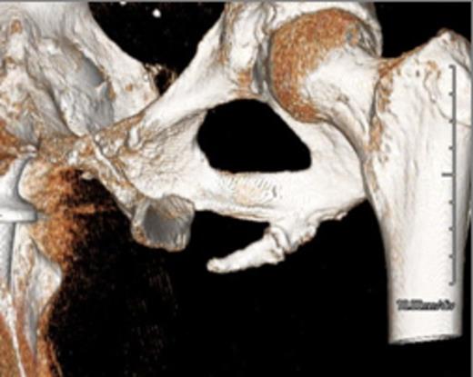 3D Reconstructed Computed Tomography demonstrating the pelvic digit