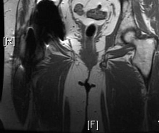 Magnetic Resonance Imaging demonstrating a pelvic digit