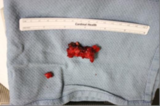 Surgical specimen of the removed pelvic digit