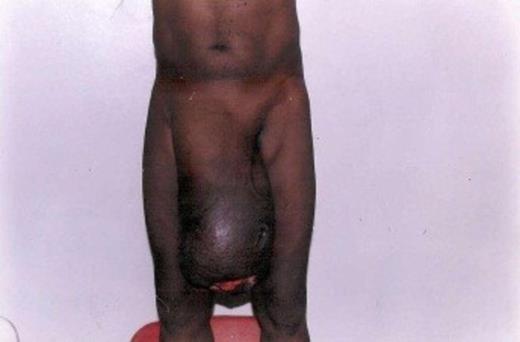 Giant inguinal hernia with ulceration pre-op.