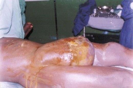 Giant inguinal hernia after Stage I: Resection of ulcer and surrounding scrotal skin, partial reduction of hernia sac contents.