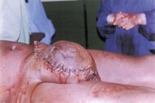Giant inguinal hernia after Stage II: Partial reduction of hernia sac contents and resection of scrotal skin