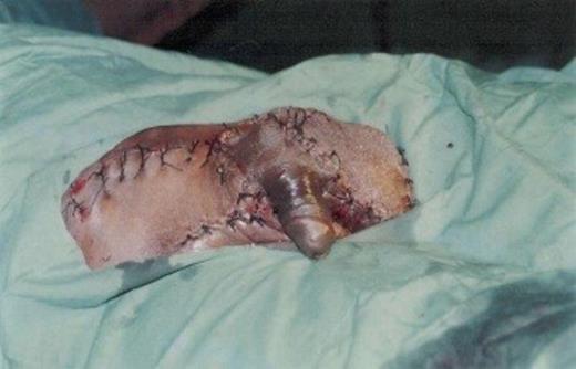 Giant inguinal hernia after Stage III: Bowel resection, ileo-colic anastomosis, hernia repair and resection of scrotal skin)