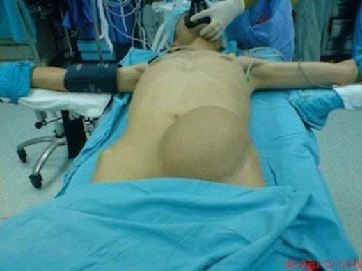 Mass was located immediately above the left groin