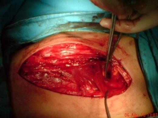 Left flank incision