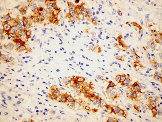 PLAP positive tumour cells (X200)