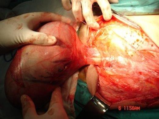 Rapidly enlarging tumour distal to the external inguinal ring.