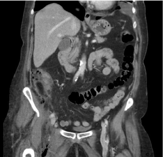 Right iliac fossa abscess
