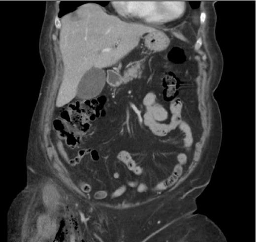 subcutaneous thigh emphysema