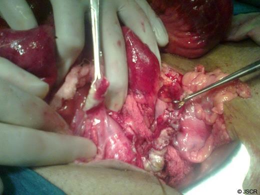 Intra-operative picture of two inflamed appendices
