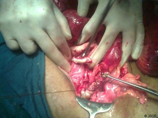 Intra-operative picture of two inflamed appendices
