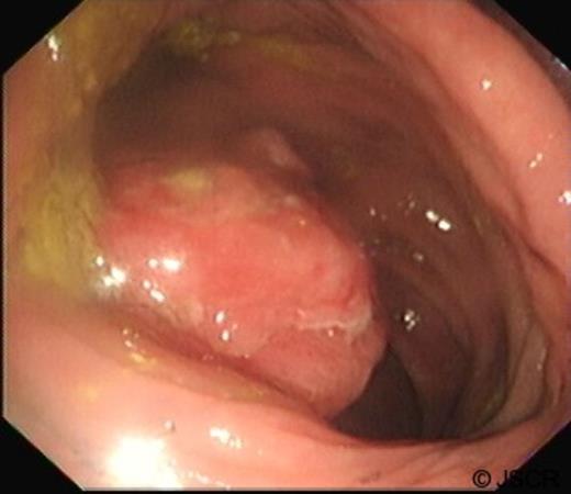 Colonoscopy demonstrating large pedunculated ulcerating lesion found at hepatic flexure
