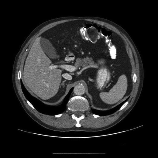 CT scan of the abdomen showing the lesion (marked A)