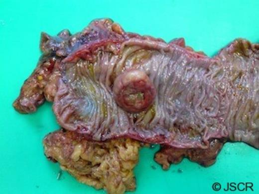 Polypoidal tumour measuring 4cm with an area of central ulceration