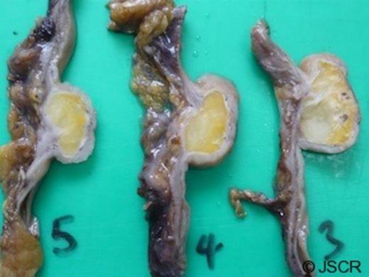 Gross slices of the tumour show adipose tissue expanding the submucosa. There are areas of fat necrosis and mucosal ulceration