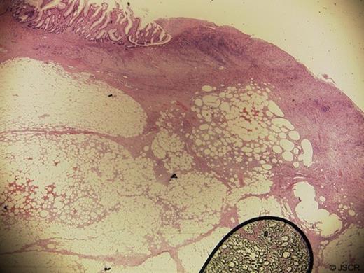 Microscopy shows lobules of mature adipocytes. There is extensive surface ulceration with underlying granulation tissue and areas of fat necrosis