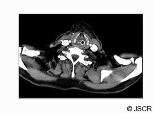 The contrast CT scan of the neck performed on day 4; showing soft tissue oedema around the orotracheal tube, oropharynx and laryngopharynx
