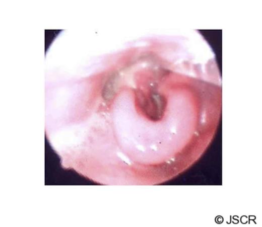 Laryngoscopy showing dramatic improvement to laryngeal oedema