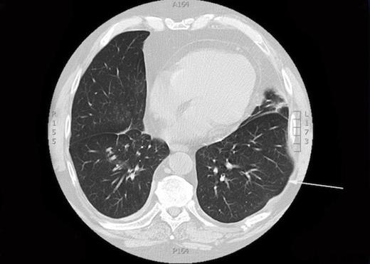 Left lung hernia