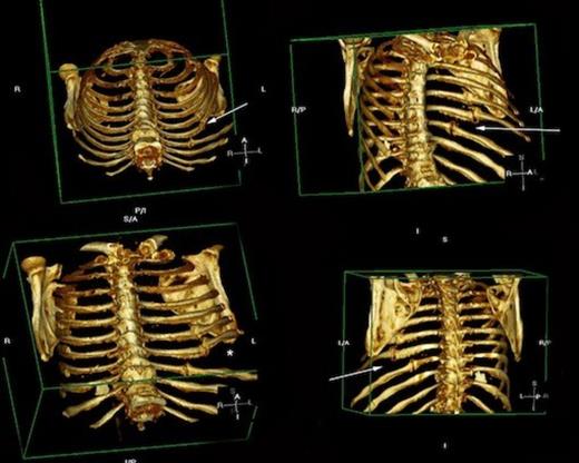 Rendered images of fractured ribs 6, 7 and 8 Arrowheads demonstrating fractures of the left 6th, 7th and 8th ribs. * = site of skeletal defect and subsequent site of pulmonary herniation