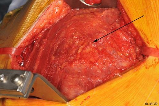 The mobilised latisssimus dorsis