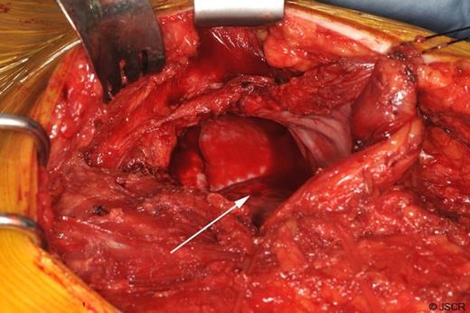 The hernial defect