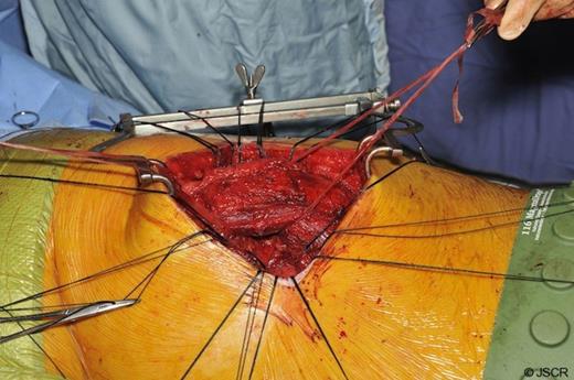 Anchoring sutures, latissimus dorsi replaced