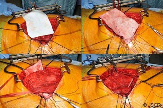 The PermacolTM bioprosthesis placement