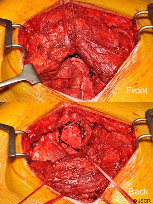 The PermacolTM bioprosthesis (Anterior and Posterior view) Latissimus Dorsi is reflected posteriorly and anteriorly respectively
