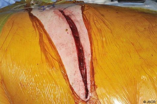 Local anaesthetic wound catheter