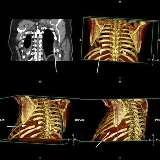 Postoperative rendered images confirming restoration of herniated lung Top left, CT demonstrating PermacolTM patch in situ. Rendered images display areas of resected ribs and the revised bony form. Lung is restored and shows no evidence of herniation.