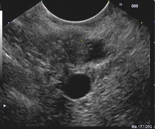 EUS demonstrating a lesion in the distal CBD