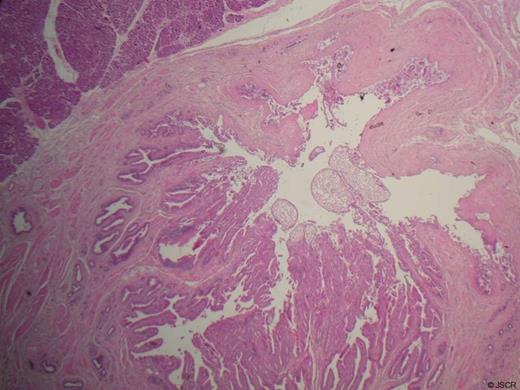 Histology at x20 magnification demonstrating cholesterol polyps at the convergence of the distal CBD and main pancreatic duct.