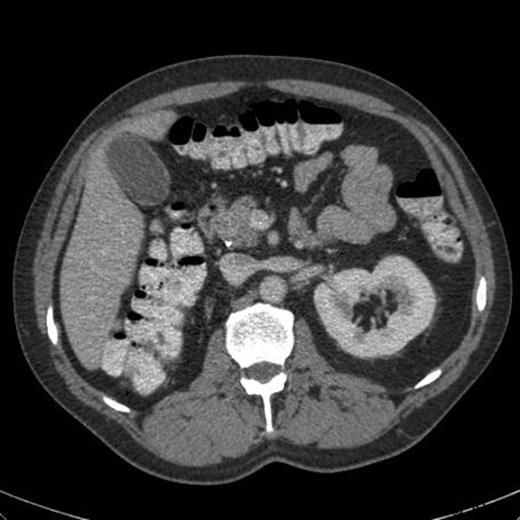CT abdomen demonstrating calcification at the head of the pancreas