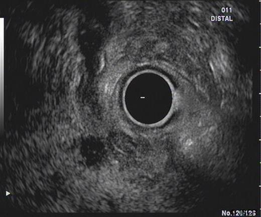 EUS demonstrating lesion at the pancreatic head with thickening of distal CBD