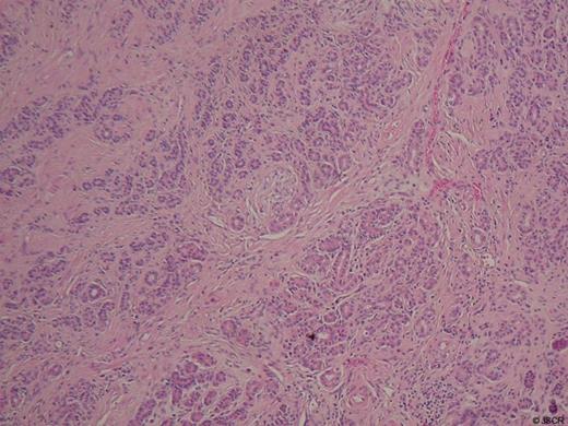 Histology at x100 magnification demonstrating glandular lobules of duct-like structures within fibrous stroma of the ampulla